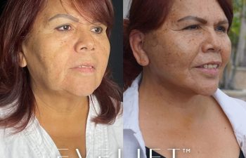 female patient before and after EVELift®