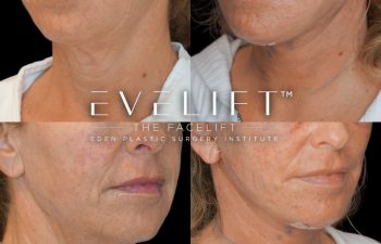 female patient before and after EVELift®