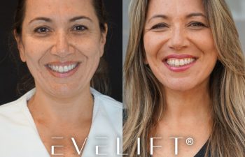 female patient before and after EVELift®