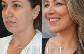female patient before and after EVELift®