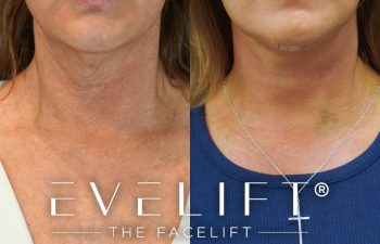 female patient before and after EVELift®