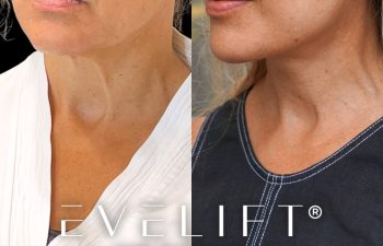 female patient before and after EVELift®