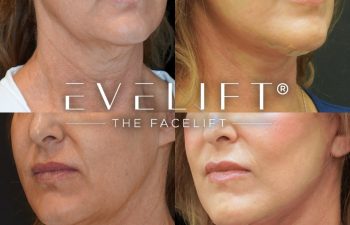female patient before and after EVELift®