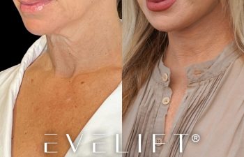 female patient before and after EVELift®