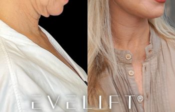 female patient before and after EVELift®