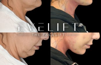 female patient before and after EVELift®