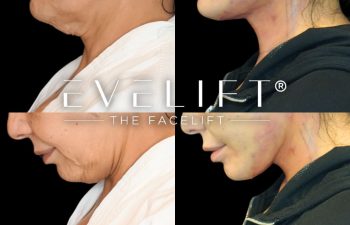female patient before and after EVELift®