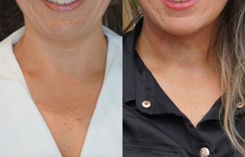 female patient before and after EVELift®