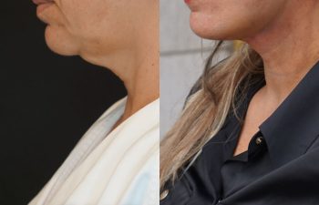 female patient before and after EVELift®