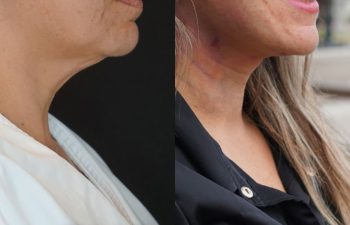 female patient before and after EVELift®