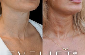 female patient before and after EVELift®