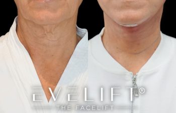 female patient before and after EVELift®