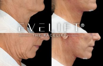 female patient before and after EVELift®