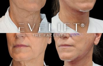 female patient before and after EVELift®