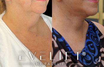 female patient before and after EVELift®