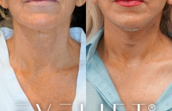 female patient before and after EVELift®