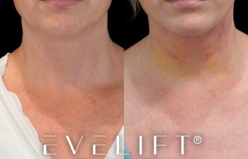 female patient before and after EVELift®