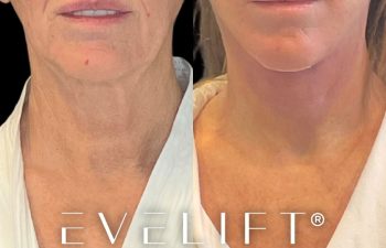 female patient before and after EVELift®