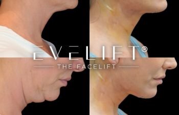female patient before and after EVELift®