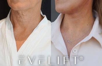 female patient before and after EVELift®