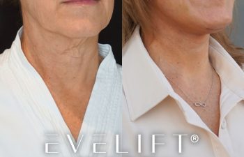 female patient before and after EVELift®