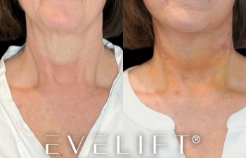 female patient before and after EVELift®