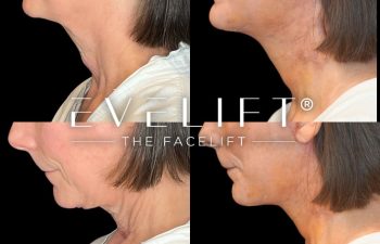 female patient before and after EVELift®