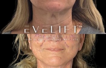 female patient before and after EVELift®