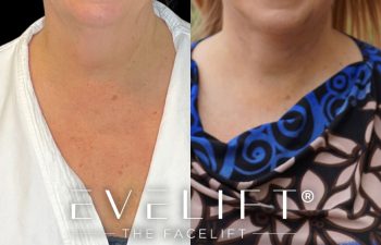 female patient before and after EVELift®