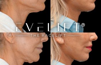 female patient before and after EVELift®