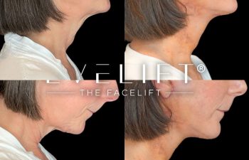 female patient before and after EVELift®