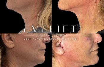 female patient before and after EVELift®