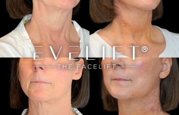 female patient before and after EVELift®