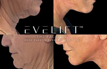 female patient before and after EVELift®