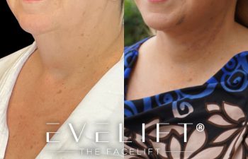 female patient before and after EVELift®