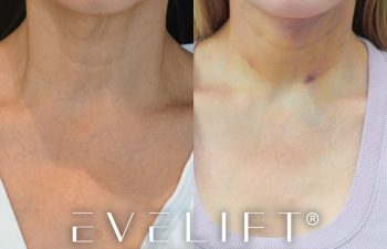 female patient before and after EVELift®