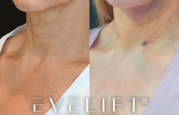 female patient before and after EVELift®