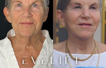female patient before and after EVELift®