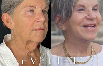 female patient before and after EVELift®