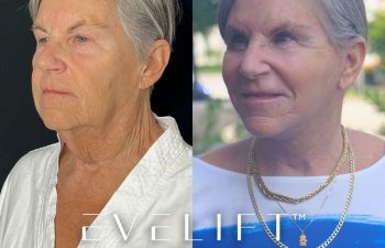 female patient before and after EVELift®