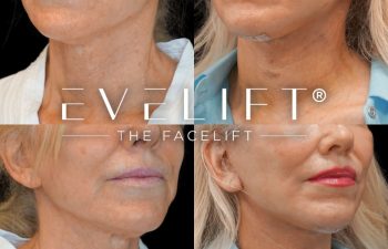 female patient before and after EVELift®