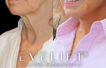 female patient before and after EVELift®