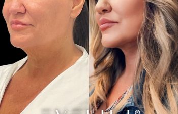 female patient before and after EVELift®