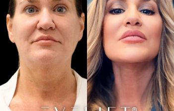 female patient before and after EVELift®