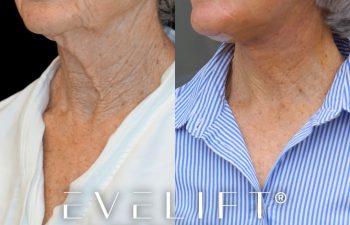 female patient before and after EVELift®