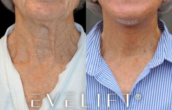 female patient before and after EVELift®