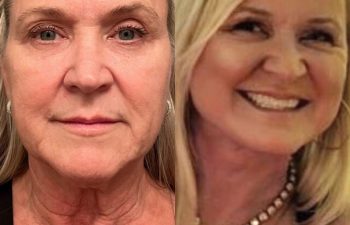 female patient before and after EVELift®