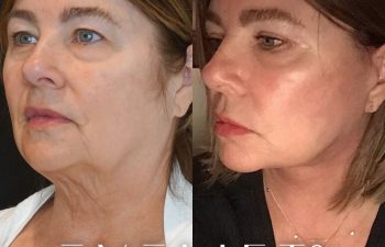 female patient before and after EVELift®