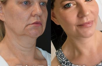 female patient before and after EVELift®
