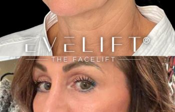 female patient before and after EVELift®